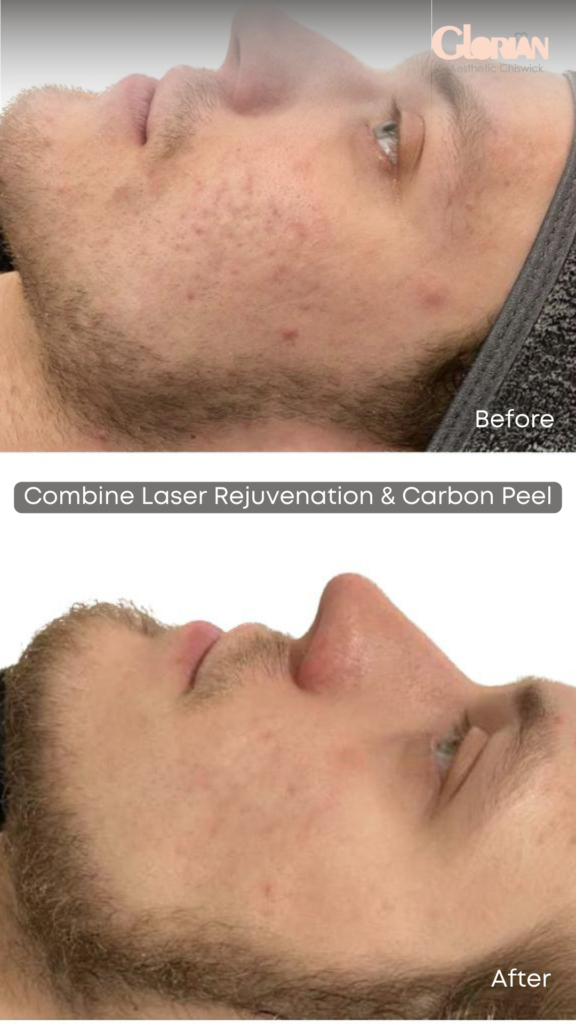 acne-treatment-in-london